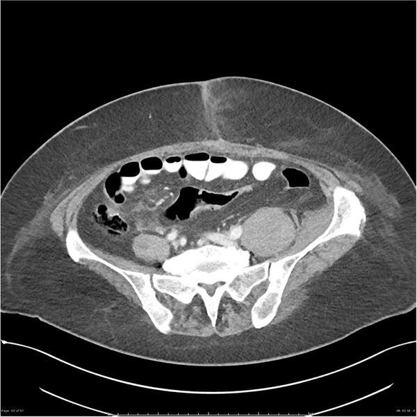 File:Bilateral psoas hematomas (Radiopaedia 24057-24279 A 62).jpg