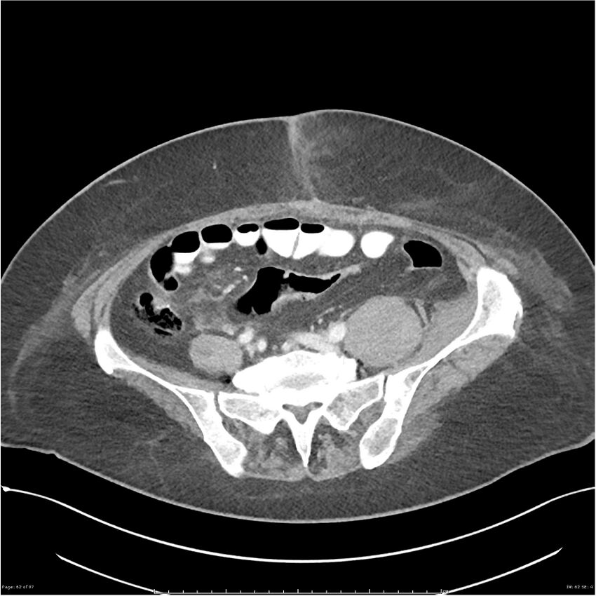 Bilateral psoas hematomas (Radiopaedia 24057-24279 A 62).jpg