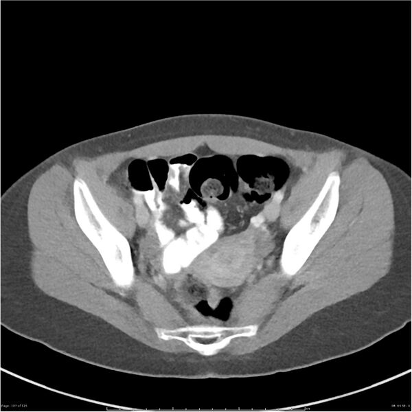 File:Bilateral ureteritis and cystitis (Radiopaedia 25340-25594 A 64).jpg