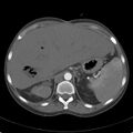 Biliary necrosis - liver transplant (Radiopaedia 21876-21846 A 18).jpg