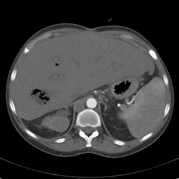 File:Biliary necrosis - liver transplant (Radiopaedia 21876-21846 A 18).jpg