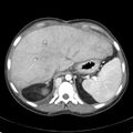 Biliary necrosis - liver transplant (Radiopaedia 21876-21846 B 15).jpg