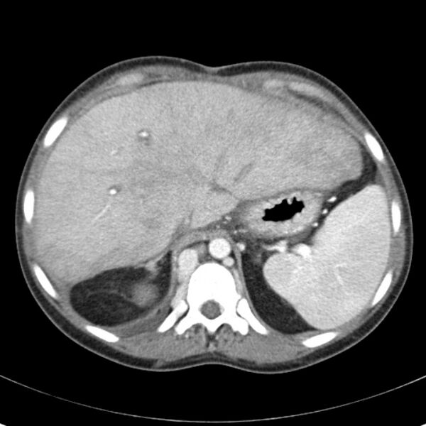 File:Biliary necrosis - liver transplant (Radiopaedia 21876-21846 B 15).jpg