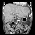 Biliary necrosis - liver transplant (Radiopaedia 21876-21846 C 14).jpg