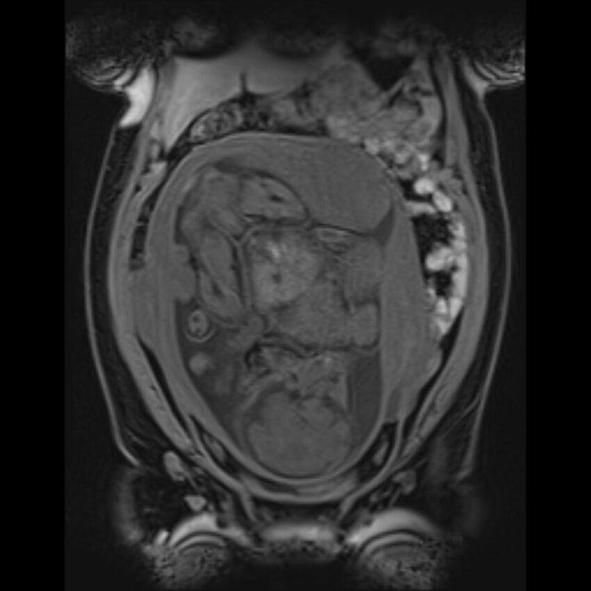 Bilobed placenta accreta (Radiopaedia 69648-79591 Coronal T1 vibe 58).jpg