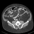 Bladder papillary urothelial carcinoma (Radiopaedia 48119-52951 A 35).png