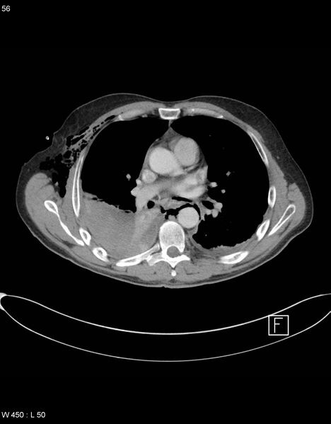 File:Boerhaave syndrome with tension pneumothorax (Radiopaedia 56794-63605 A 27).jpg