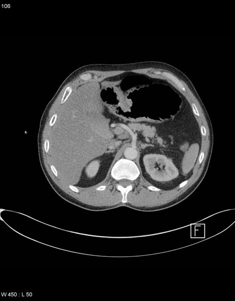 File:Boerhaave syndrome with tension pneumothorax (Radiopaedia 56794-63605 A 52).jpg