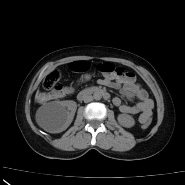 File:Bosniak renal cyst - type I (Radiopaedia 27479-27675 Axial non-contrast 41).jpg