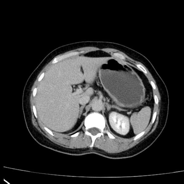 File:Bosniak renal cyst - type I (Radiopaedia 27479-27675 D 5).jpg