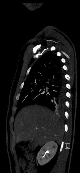 File:Brachiocephalic trunk pseudoaneurysm (Radiopaedia 70978-81191 C 26).jpg