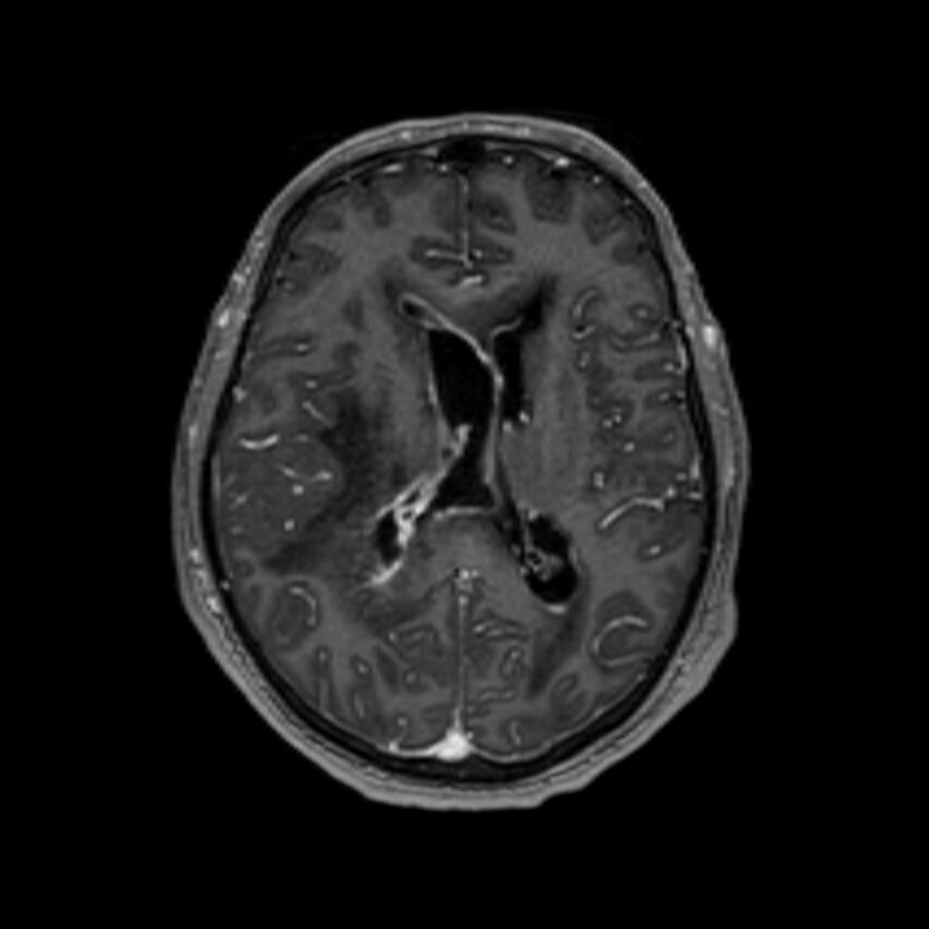 Brain abscess complicated by intraventricular rupture and ventriculitis (Radiopaedia 82434-96577 Axial T1 C+ 39).jpg