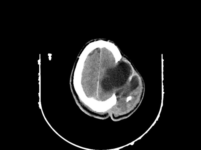 Brain injury by firearm projectile (Radiopaedia 82068-96088 A 178).jpg