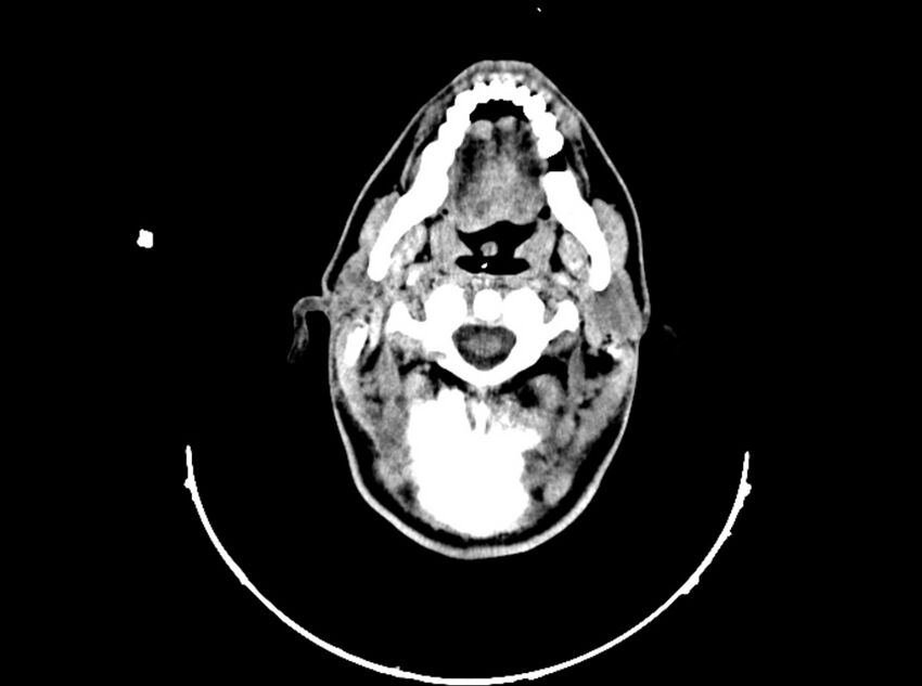 Brain injury by firearm projectile (Radiopaedia 82068-96088 A 53).jpg
