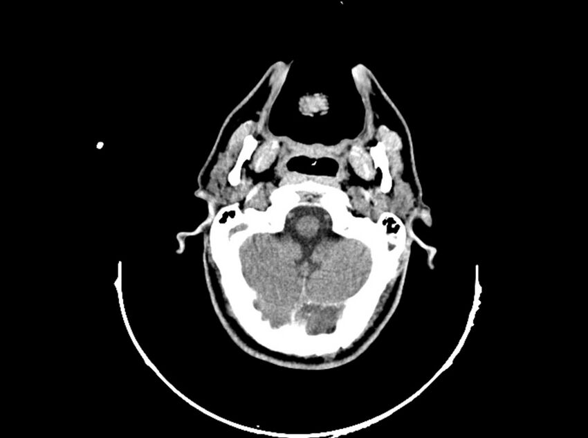 Brain injury by firearm projectile (Radiopaedia 82068-96088 A 66).jpg