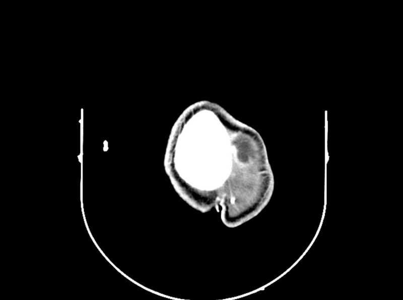 File:Brain injury by firearm projectile (Radiopaedia 82068-96088 B 200).jpg
