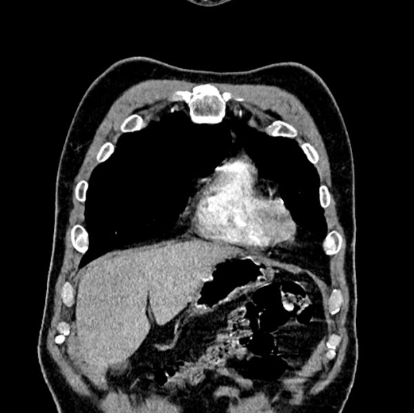 File:Brain metastases - lung cancer primary (Radiopaedia 75060-86116 C+ arterial phase 8).jpg