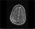 Brainstem glioma (Radiopaedia 21819-21775 Axial T2 32).jpg