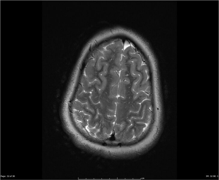 File:Brainstem glioma (Radiopaedia 21819-21775 Axial T2 32).jpg