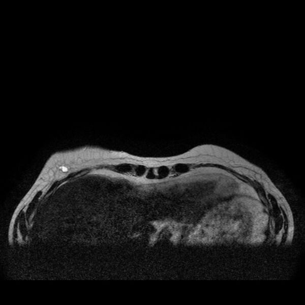 File:Breast implants - MRI (Radiopaedia 26864-27035 Axial T2 3).jpg