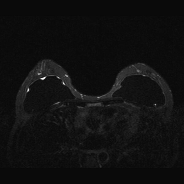 File:Breast implants - MRI (Radiopaedia 26864-27035 T2 SPAIR 24).jpg