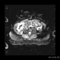 Broad ligament fibroid (Radiopaedia 49135-54241 Axial ADC 2).jpg