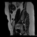 Broad ligament fibroid (Radiopaedia 49135-54241 Sagittal T2 24).jpg
