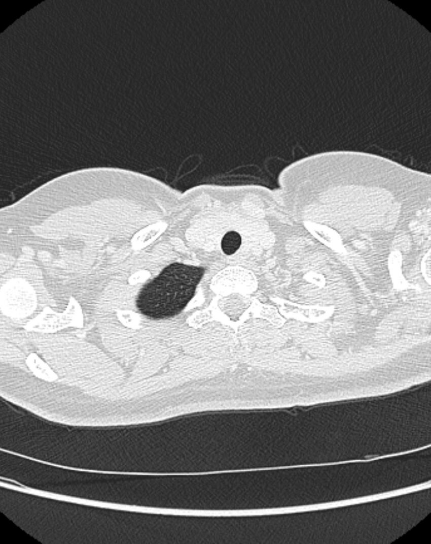 Bronchial atresia (Radiopaedia 50007-55297 Axial lung window 3).jpg