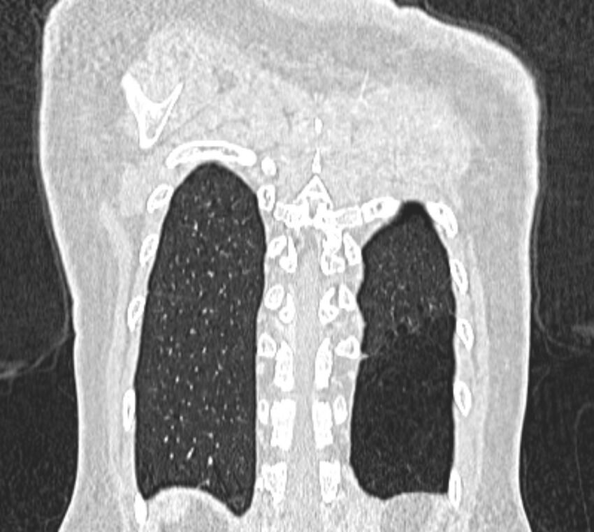 Bronchial atresia (Radiopaedia 50007-55297 Coronal lung window 106).jpg
