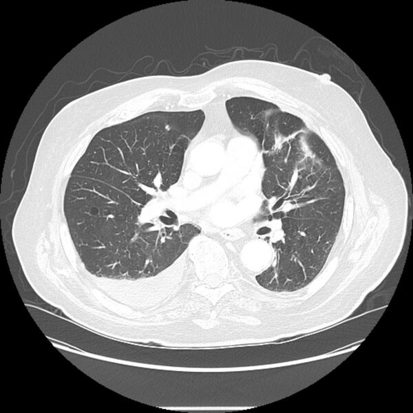 File:Bronchogenic adenocarcinoma and pulmonary embolism (Radiopaedia 9097-9806 Axial lung window 15).jpg
