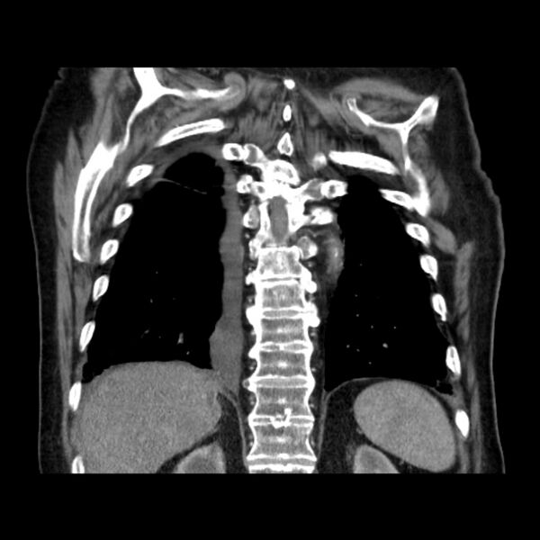 File:Bronchogenic adenocarcinoma and pulmonary embolism (Radiopaedia 9097-9806 C 40).jpg
