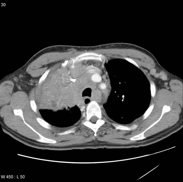 File:Bronchogenic carcinoma (Radiopaedia 8857-9645 A 6).jpg