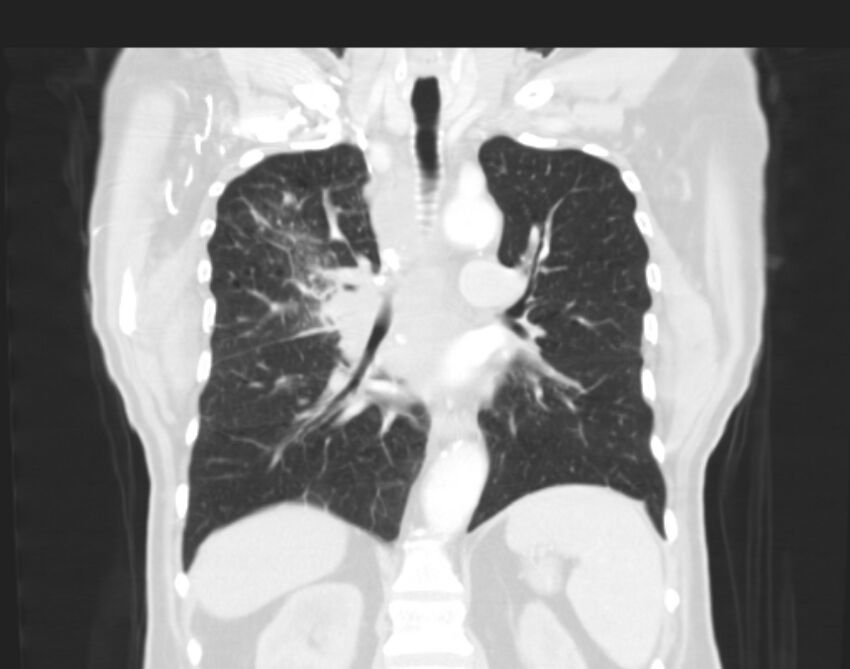 Bronchogenic carcinoma with lymphangitic spread (Radiopaedia 29002-29357 Coronal lung window 40).jpg