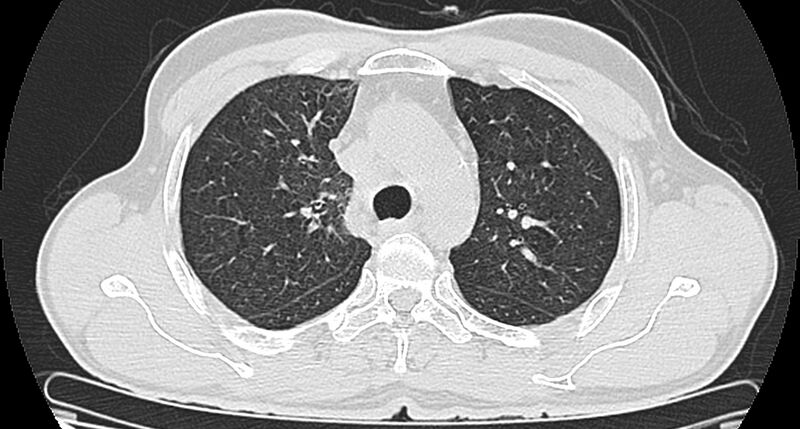 File:Bronchogenic carcinoma with superior vena cava syndrome (Radiopaedia 36497-38054 Axial lung window 33).jpg
