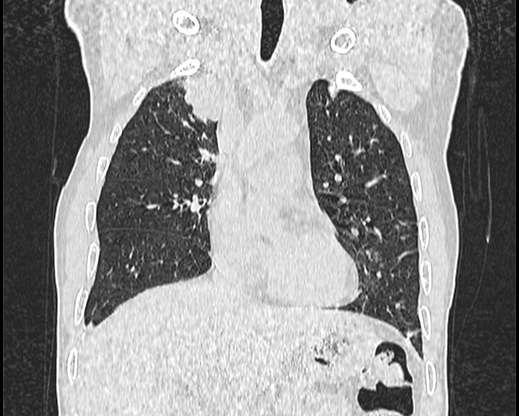 File:Bronchogenic carcinoma with superior vena cava syndrome (Radiopaedia 36497-38054 Coronal lung window 14).jpg
