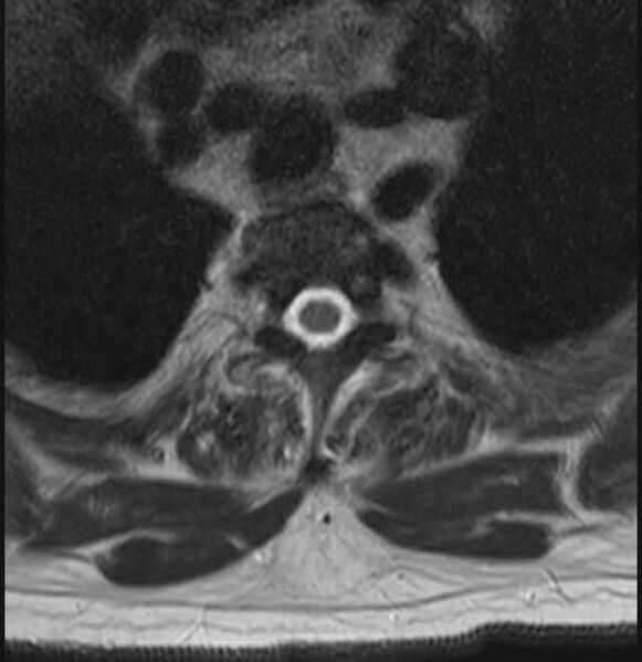 File:Brown tumors compressing the spinal cord (Radiopaedia 68442-78030 A 48).jpg