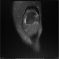 Bucket handle tear - lateral meniscus (Radiopaedia 7246-8187 Coronal T2 fat sat 19).jpg