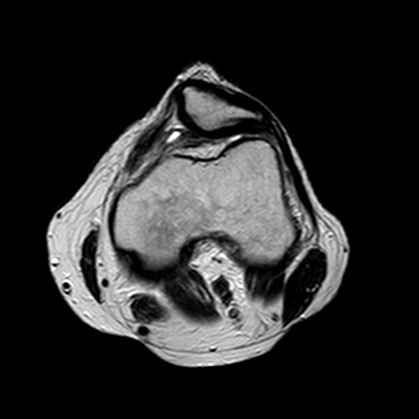 File:Bucket handle tear - medial meniscus (Radiopaedia 29250-29664 Axial T2 13).jpg