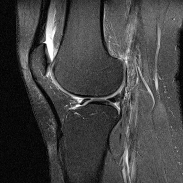 File:Bucket handle tear - medial meniscus (Radiopaedia 79028-91942 Sagittal PD fat sat 8).jpg