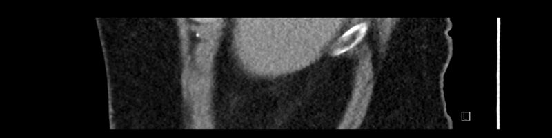 File:Buried bumper syndrome - gastrostomy tube (Radiopaedia 63843-72575 Sagittal Inject 111).jpg