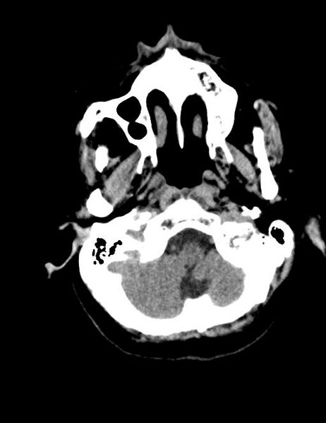 File:Burnt-out meningioma (Radiopaedia 51557-57337 Axial non-contrast 2).jpg