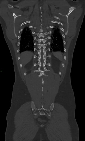 File:Burst fracture (Radiopaedia 83168-97542 Coronal bone window 60).jpg