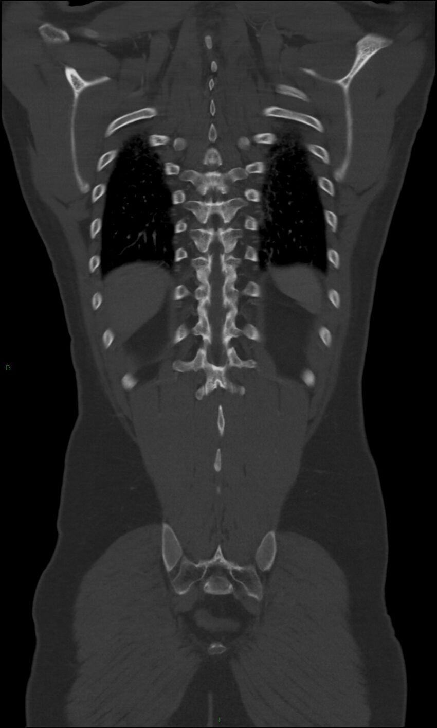 Burst fracture (Radiopaedia 83168-97542 Coronal bone window 60).jpg