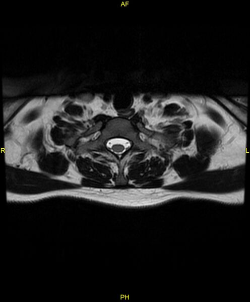 File:C5 nerve sheath tumor (Radiopaedia 85777-101596 Axial T2 73).jpg