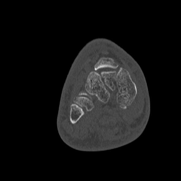 File:Calcaneal tuberosity avulsion fracture (Radiopaedia 22649-22668 Coronal bone window 37).jpg