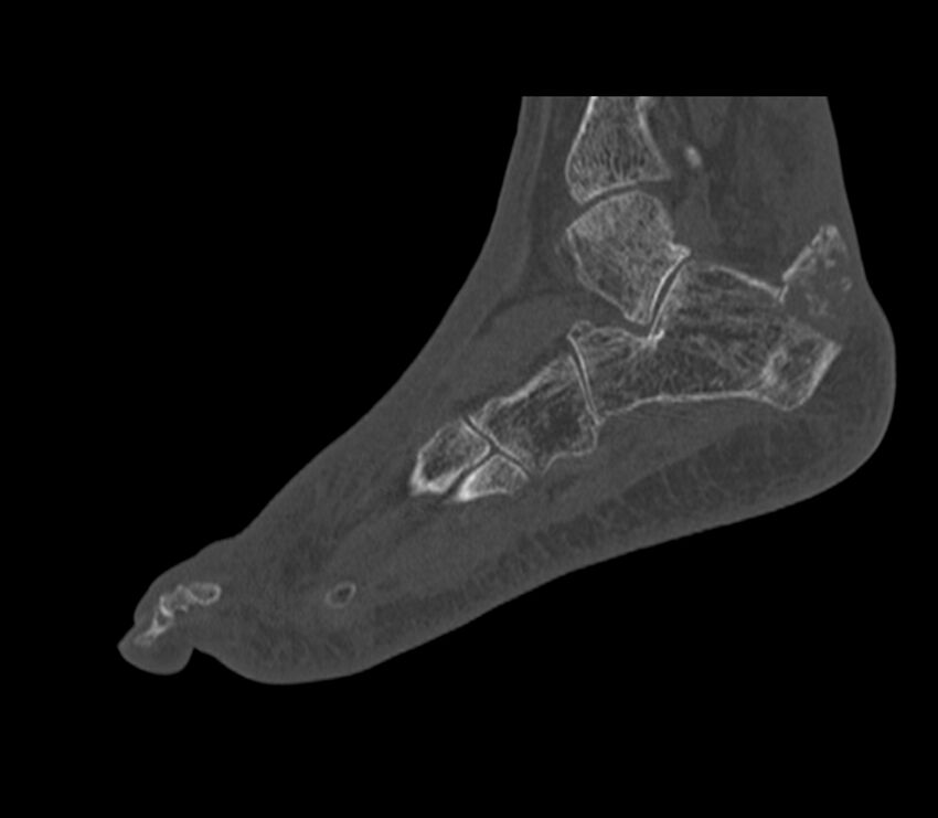 Calcaneal tuberosity avulsion fracture (Radiopaedia 22649-22668 Sagittal bone window 14).jpg