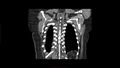 Calcified spleen (Radiopaedia 60952-68768 Coronal non-contrast 11).jpg