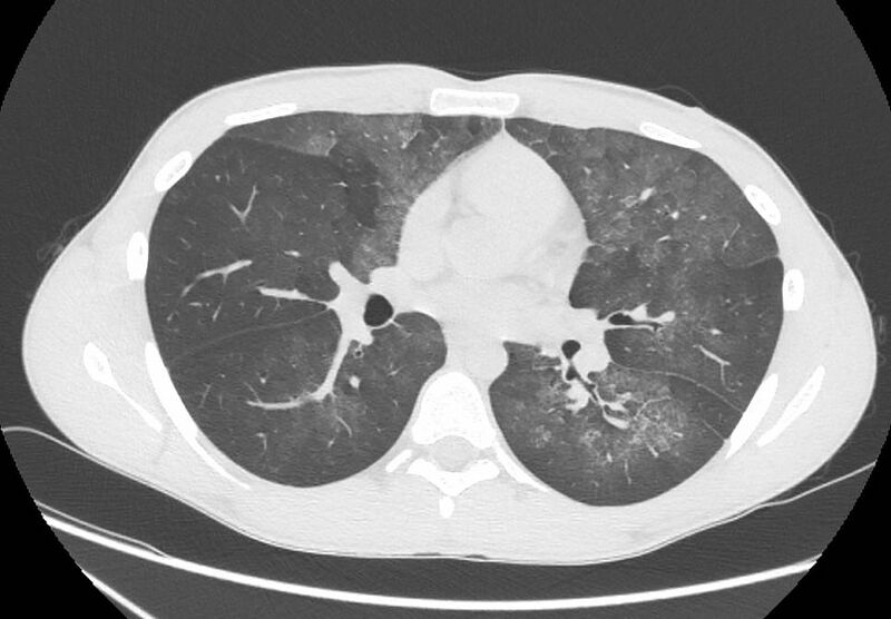File:Cannabis-induced diffuse alveolar hemorrhage (Radiopaedia 89834-106946 Axial lung window 57).jpg
