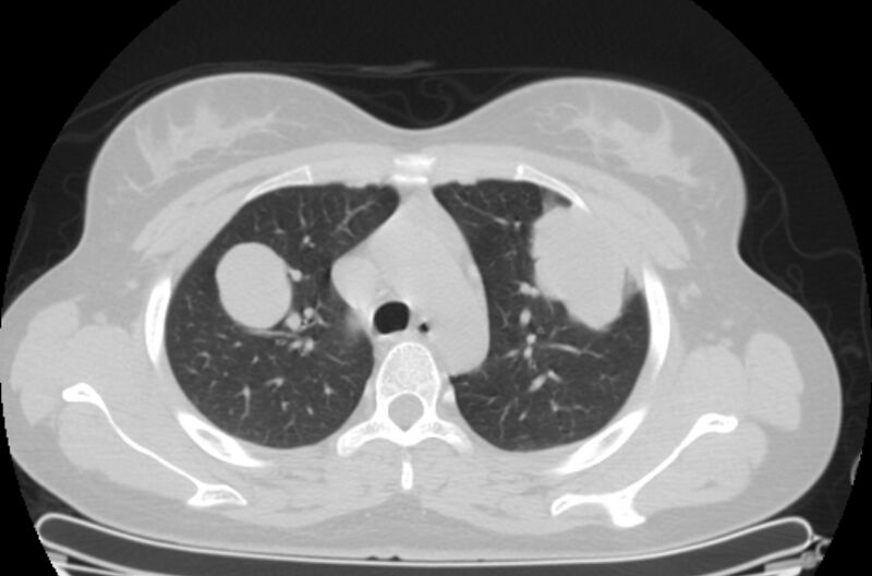 File:Cannonball metastases - uterine choriocarcinoma (Radiopaedia 70137-80173 Axial lung window 19).jpg