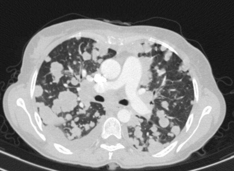 File:Cannonball metastases from breast cancer (Radiopaedia 91024-108569 Axial lung window 39).jpg
